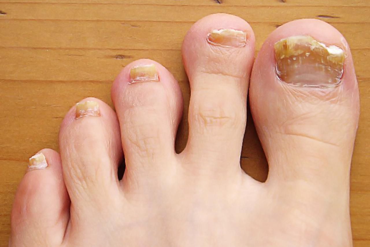 An Overview of Common Toenail Problems