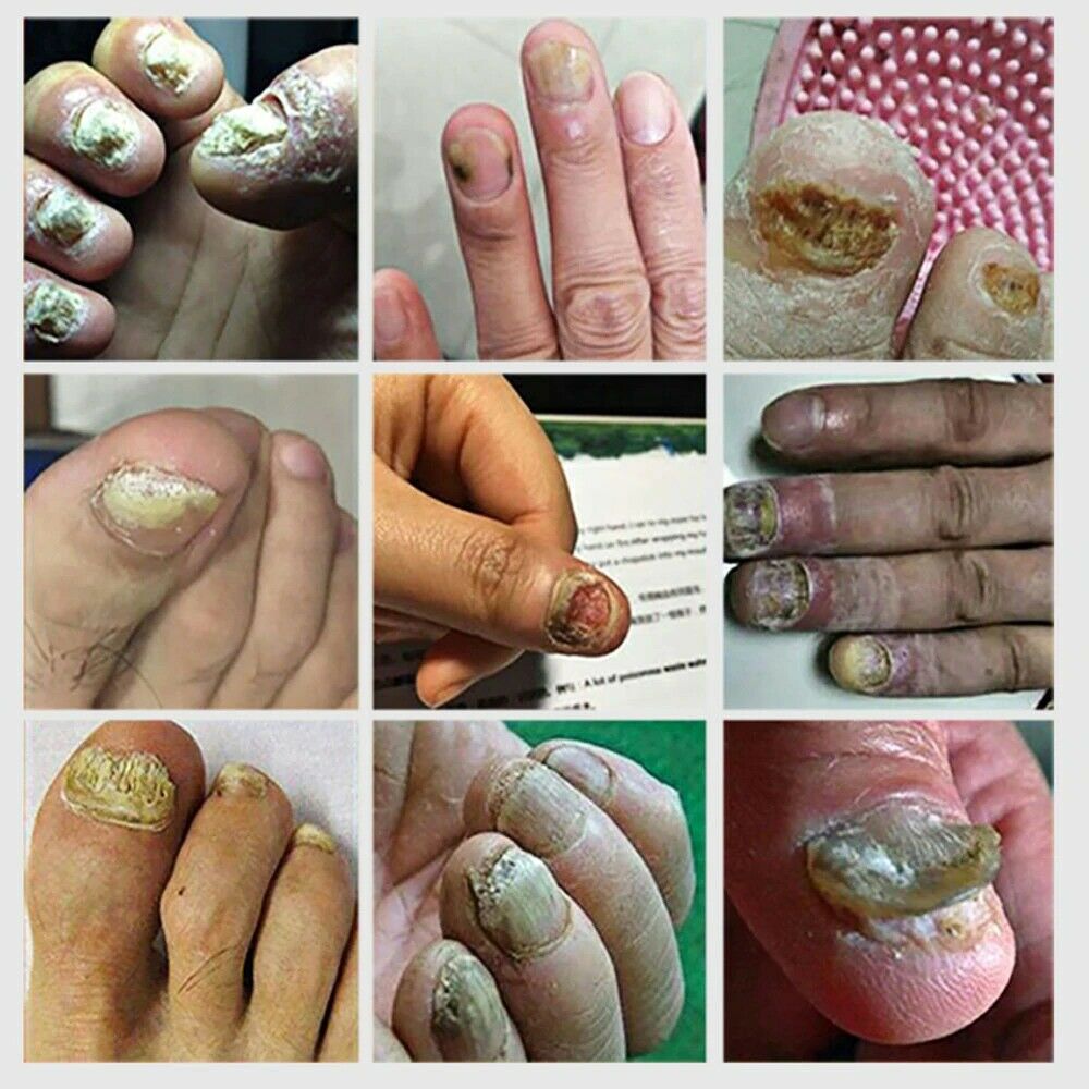 Anti Fungal Nail Treatment Liquid Toe Nail Finger Fungus ...