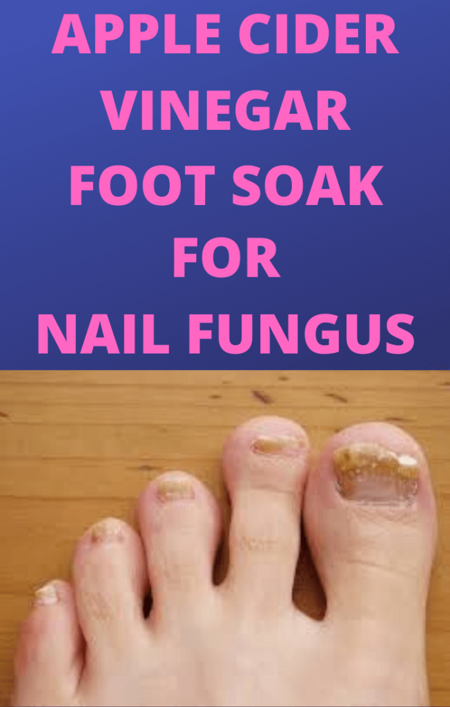 Apple Cider Vinegar Foot Soak For Nail Fungus (It Works)