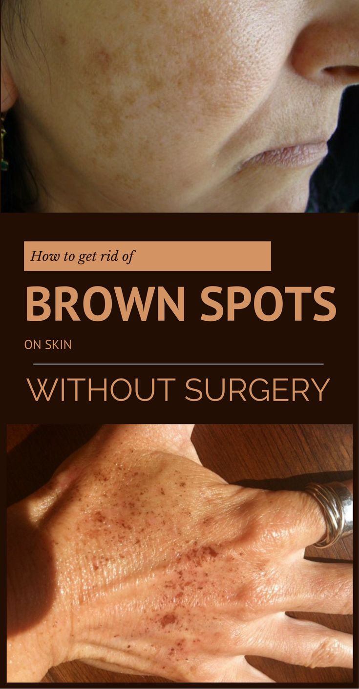 As 25 melhores ideias de Brown spots on skin no Pinterest ...