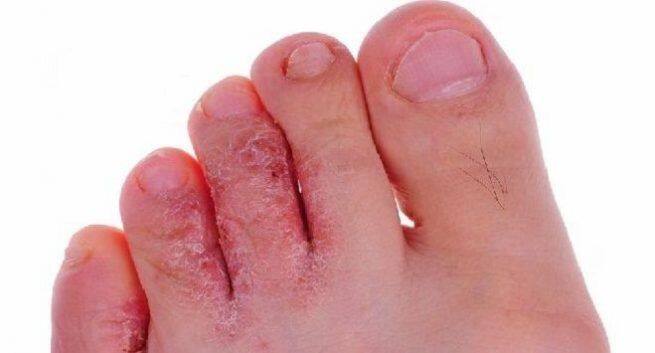 Athletes Foot: Five Home Remedies to Kill the Fungus and ...