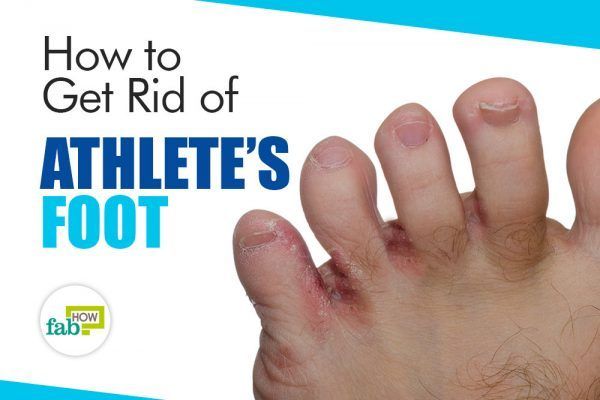 Athletes Foot: Natural Treatments for Relief