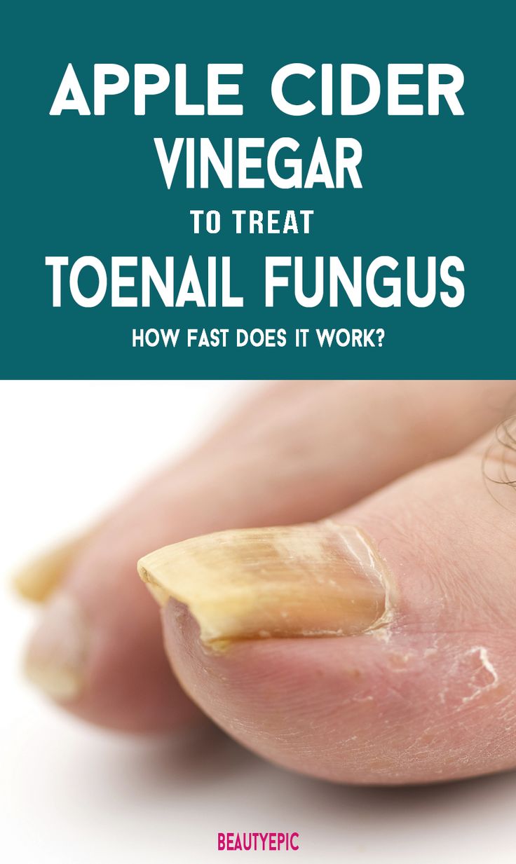 Best 25+ Toenail fungus pictures ideas on Pinterest