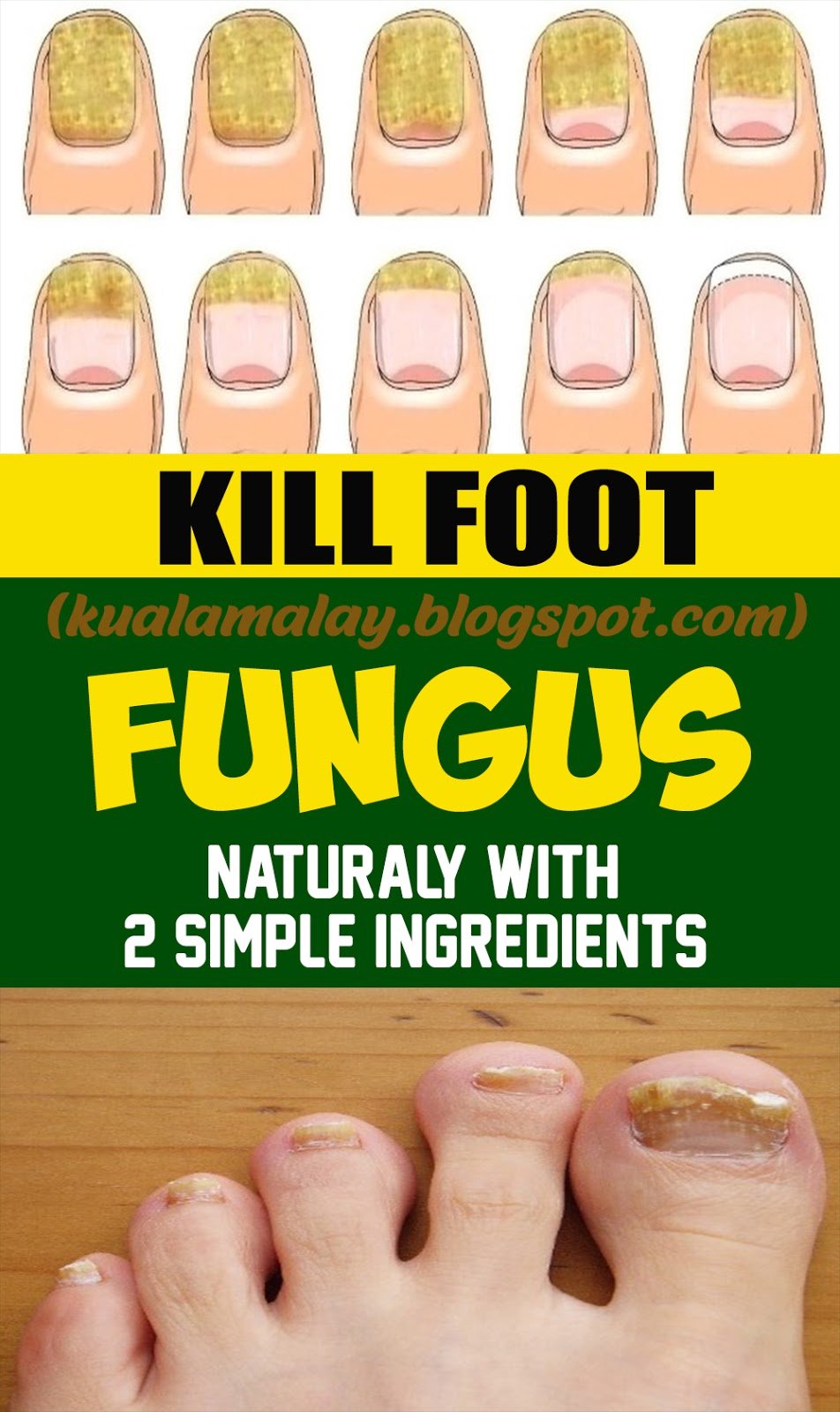 Best and Simple Home Remedy to Remove Toenail Fungus