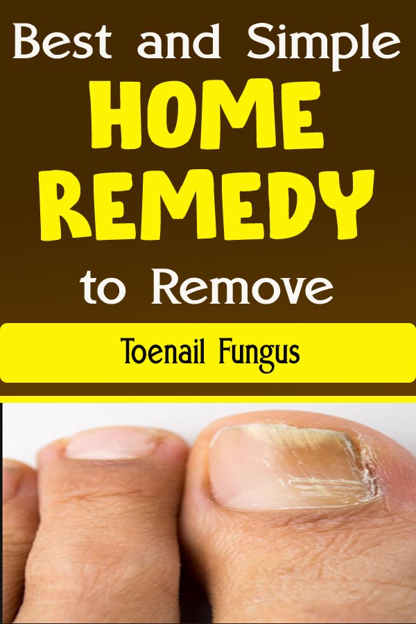 Best and Simple Home Remedy to Remove Toenail Fungus ...