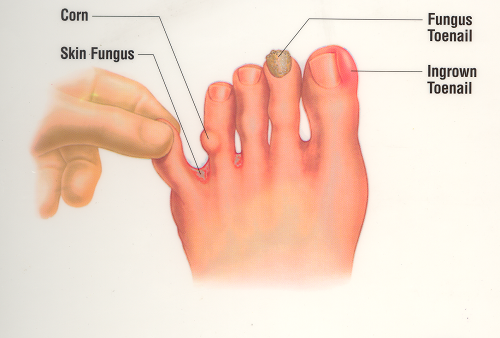 Best Cures For Toenail Fungus: How Do You Get Rid of ...