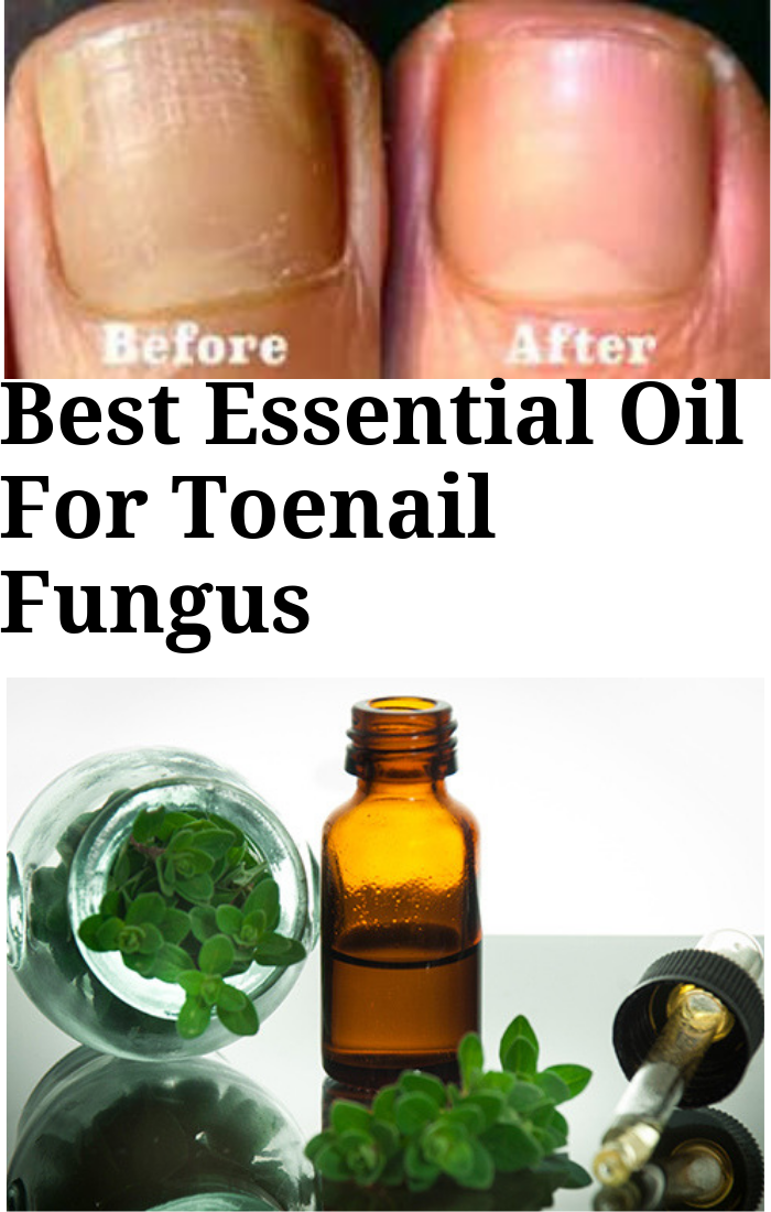 Best Essential Oil For Toenail Fungus