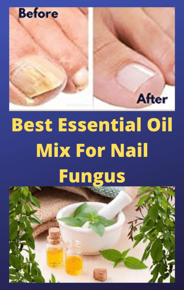 Best Essential Oil Mix For Nail Fungus That Works In 2021
