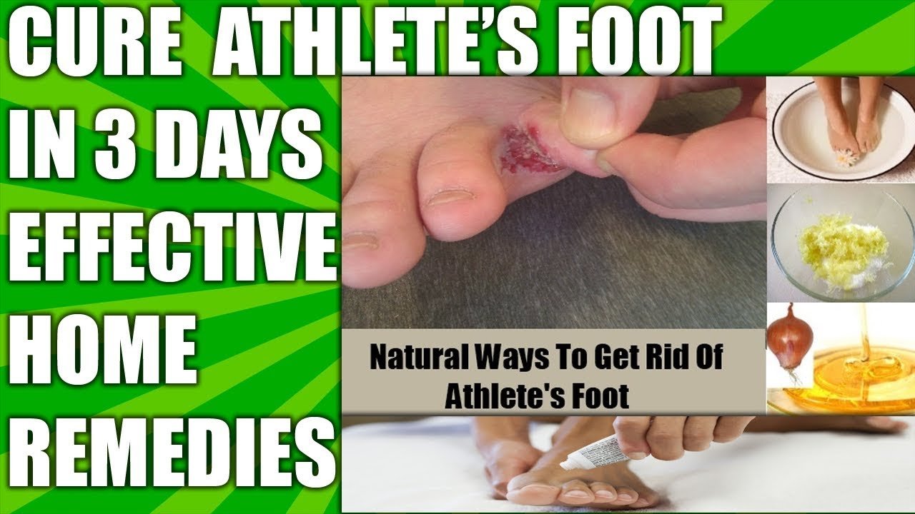 BEST HOME REMEDIES FOR ATHLETE