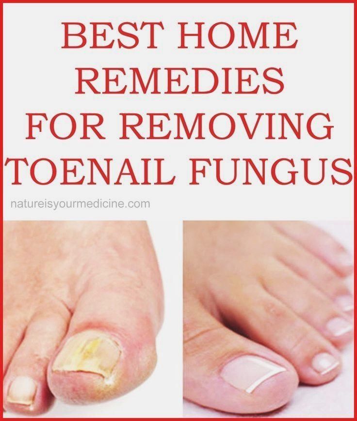 BEST HOME REMEDIES FOR REMOVING TOENAIL FUNGUS #NailFunguscurefinger # ...