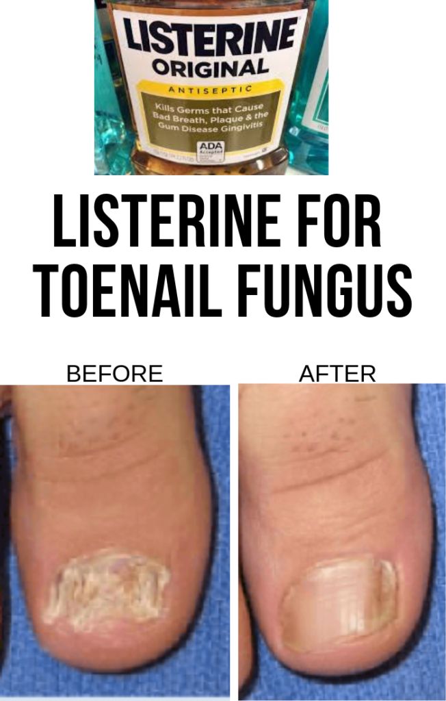 Best Listerine for Toenail Fungus in 2021 and Beyond