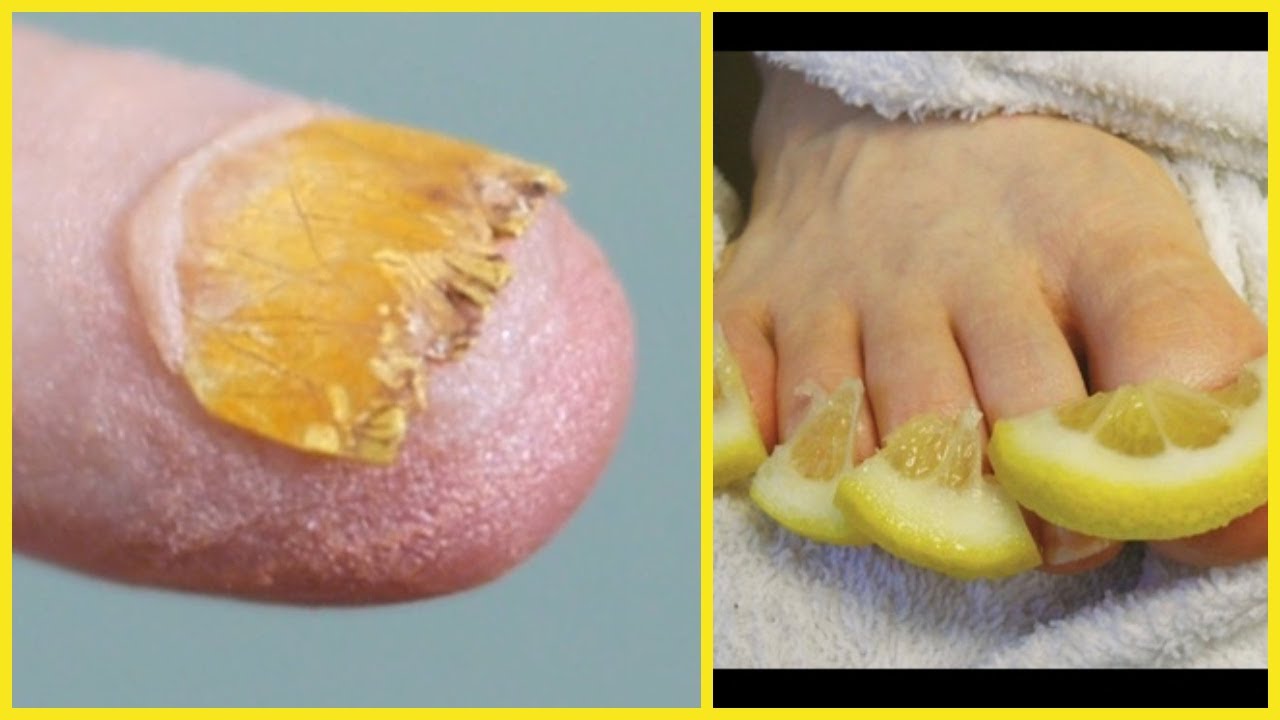 Best natural home remedies for nail fungus that really works
