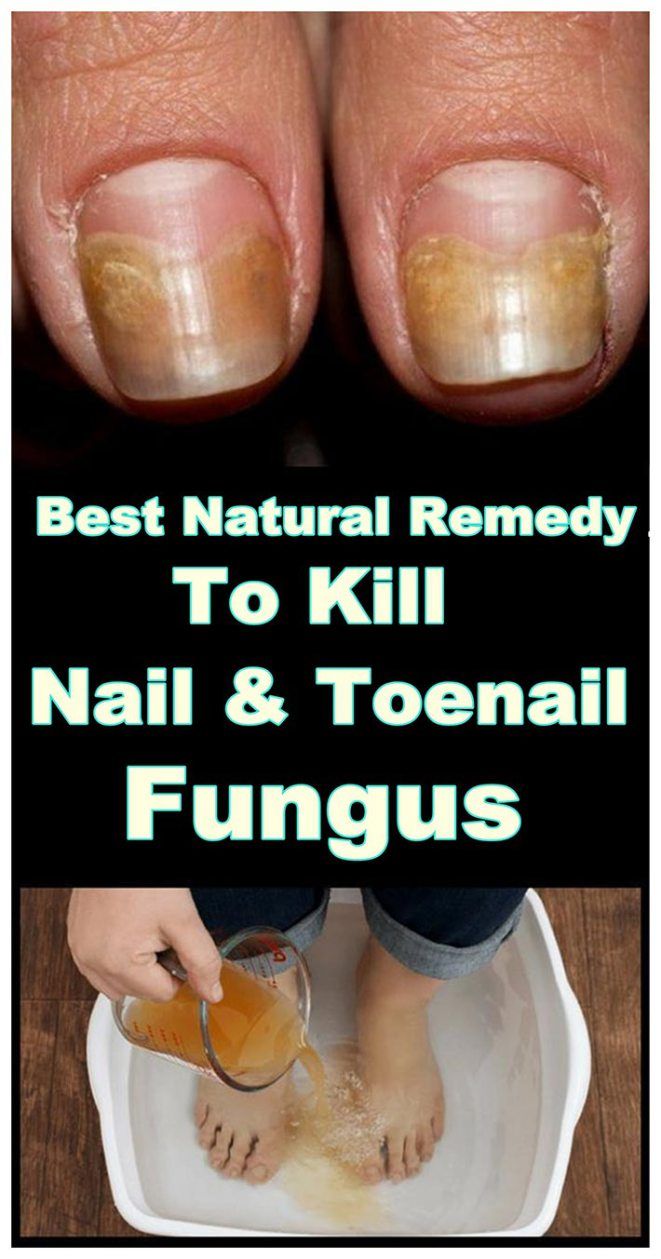 Best Natural Remedy To Kill Nail And Toenail Fungus