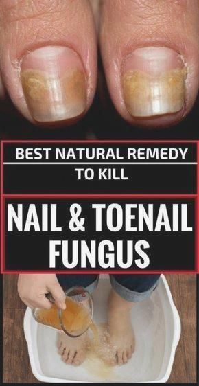 Best Natural Remedy To Kill Nail And Toenail Fungus Useful healthy tips ...