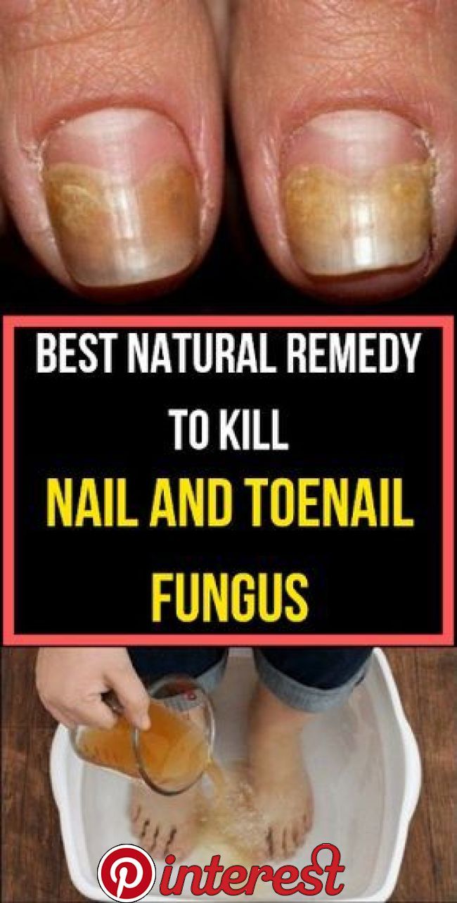 Best Natural Remedy To Kill Nail And Toenail Fungus (With ...