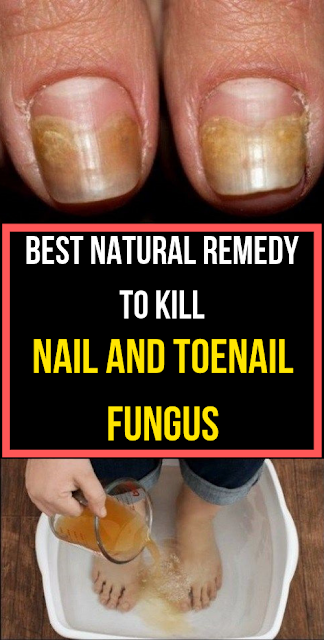 Best Natural Remedy To Kill Nail And Toenail Fungus ...