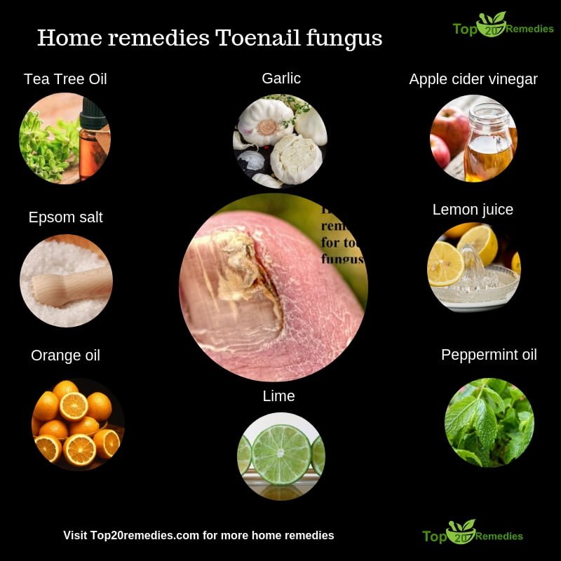 Best over the counter toenail fungus treatment