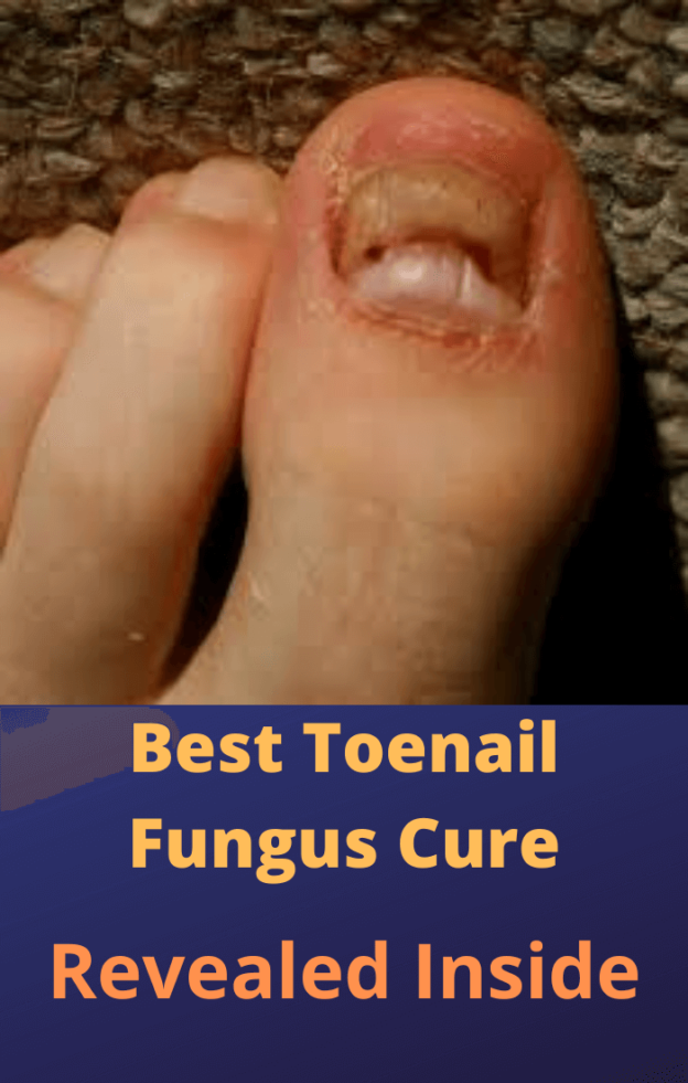 Best Toenail Fungus Cure That Works Effectively in 2021