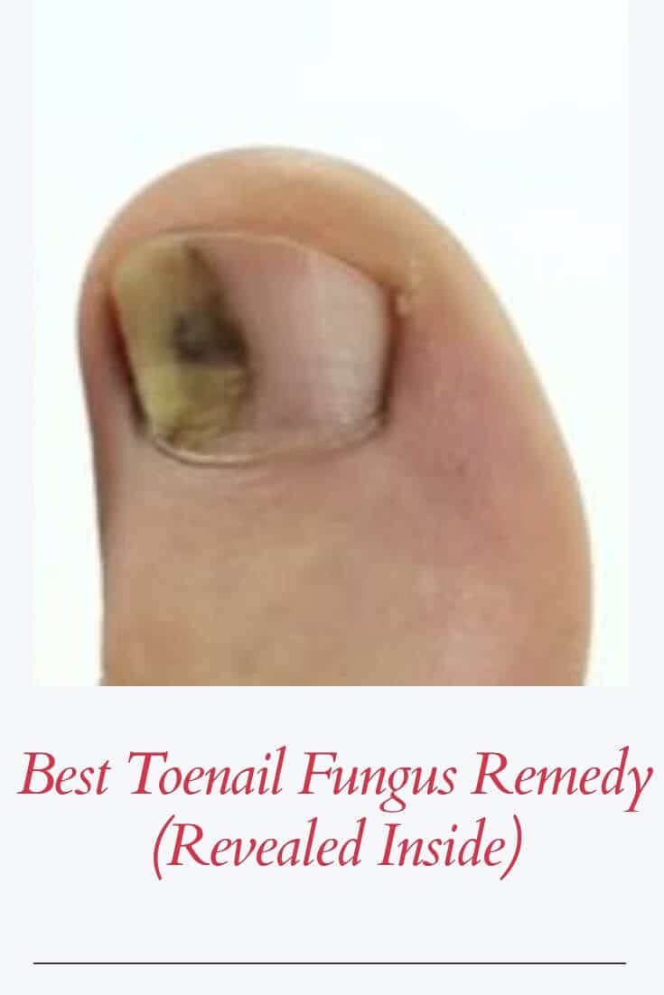 Best Toenail Fungus Remedy That Is Effective In 2021