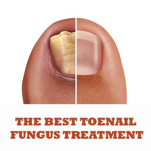 Best Toenail Fungus Treatment Products