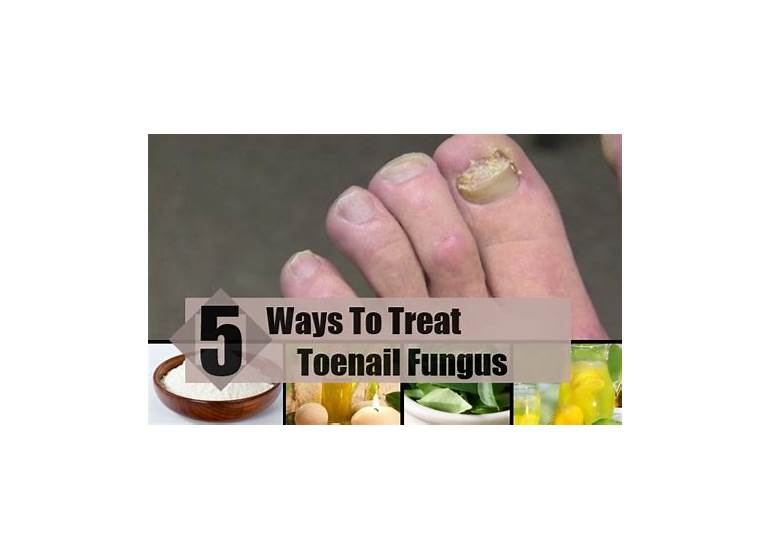 Best Way To Cure Toenail Fungus