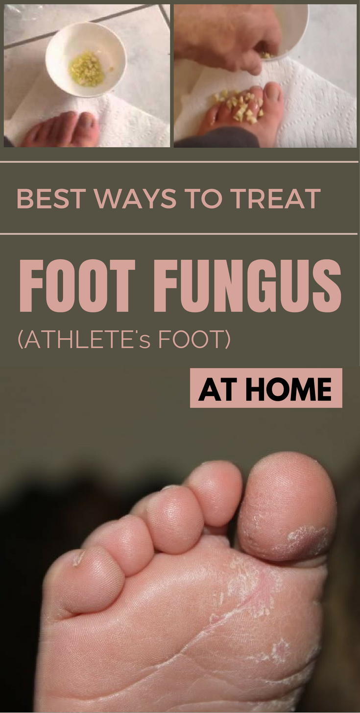 Best Ways to Treat Foot Fungus (Athletes Foot) at Home ...