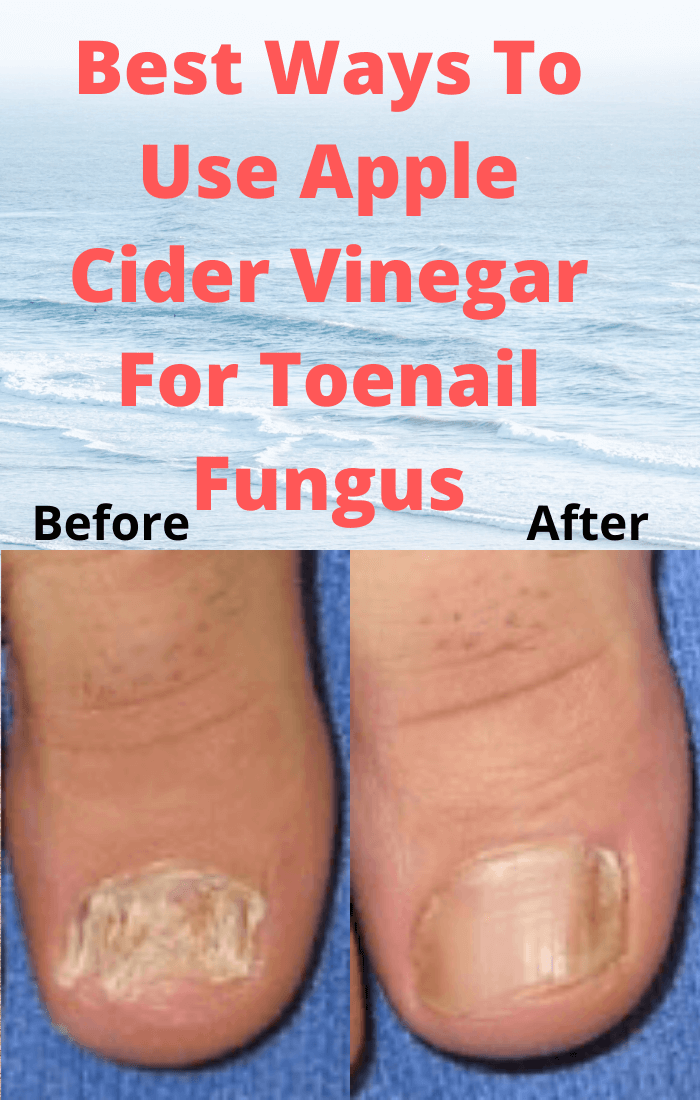 Best Ways To Use Apple Cider Vinegar For Toenail Fungus