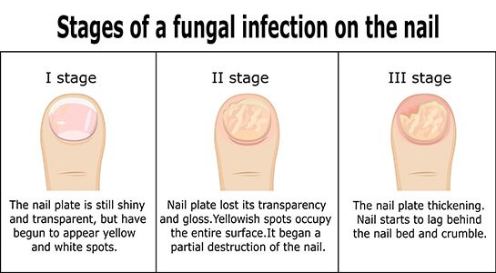 Black Toenail Fungus: Causes, Home Remedies, Treatments And More ...