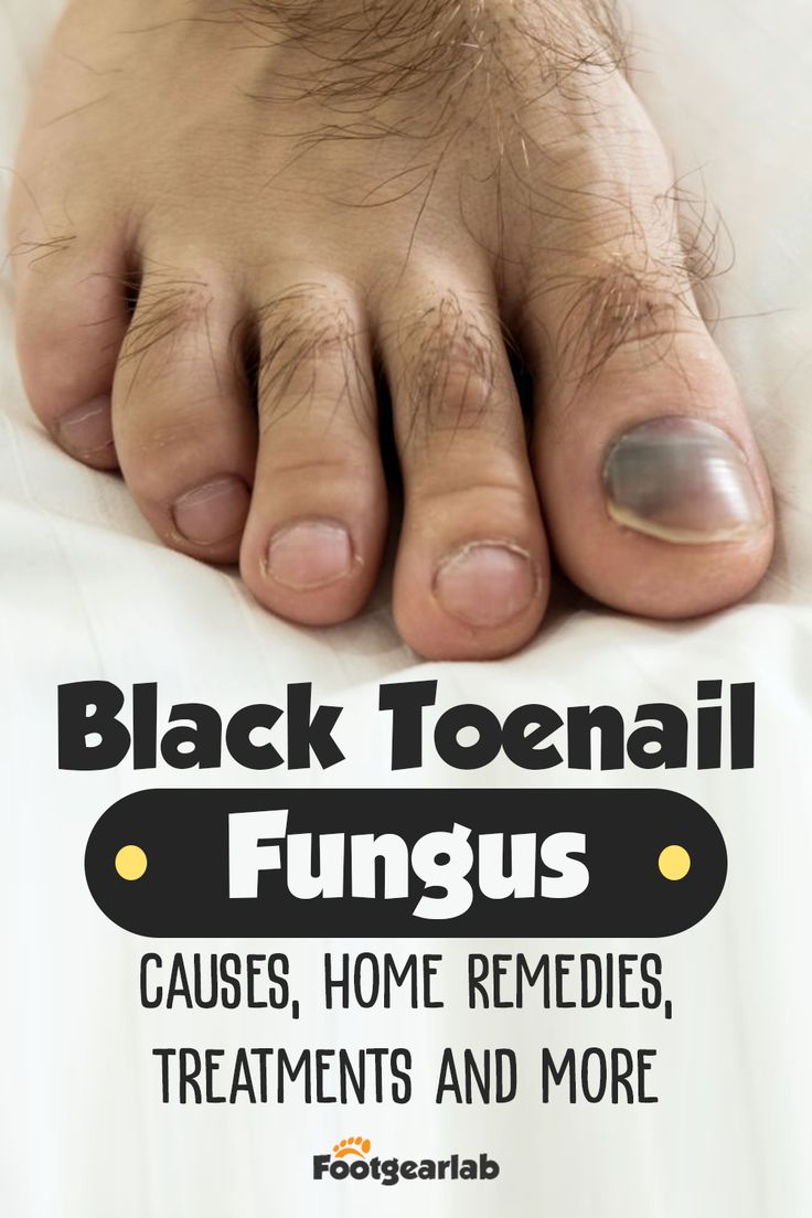 Black Toenail Fungus: Causes, Home Remedies, Treatments ...
