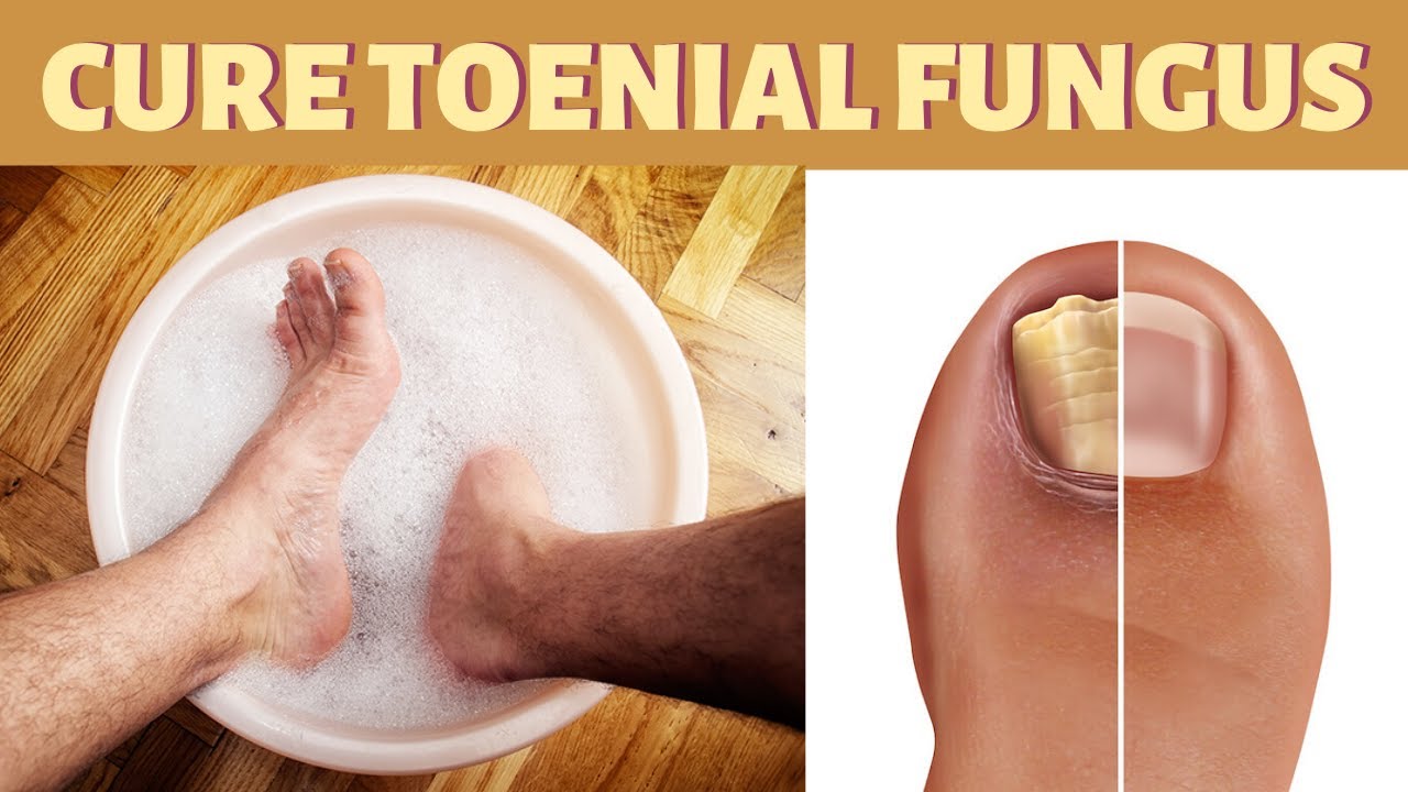 Bleach Foot Soak to Get Rid Of Toenail Fungus Naturally Fast and ...