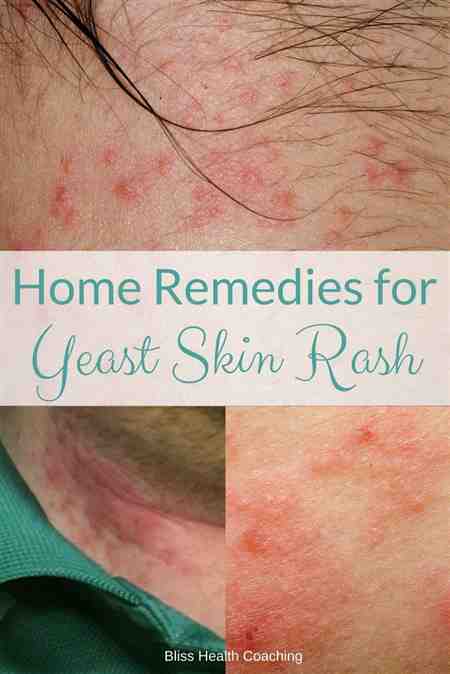 Can A Yeast Infection Spread To Your Back Pics Rash ...