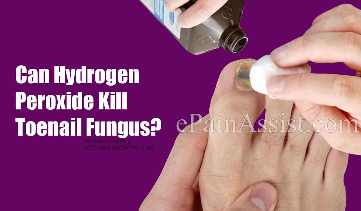 Can Hydrogen Peroxide Kill Toenail Fungus? How About ...