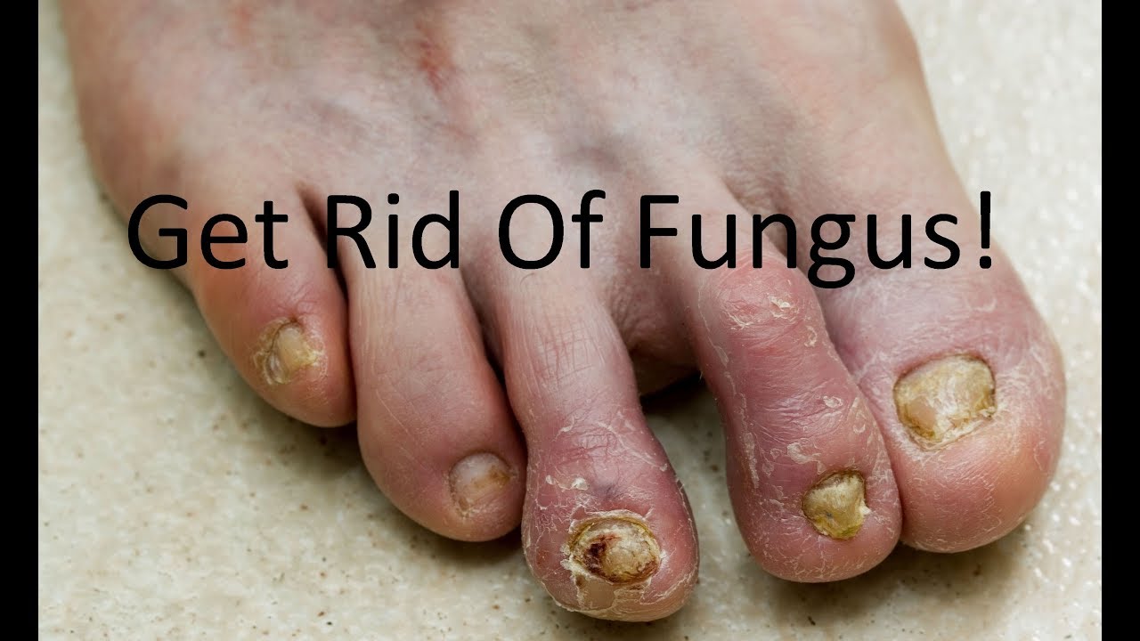 Can I Put Nail Polish Over Toenail Fungus