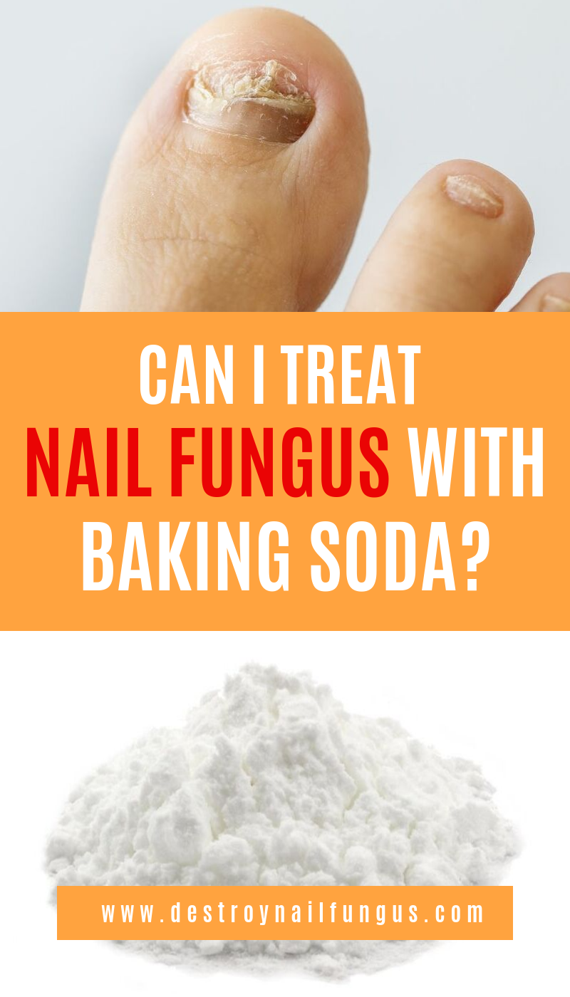 Can I Treat Nail Fungus With Baking Soda?