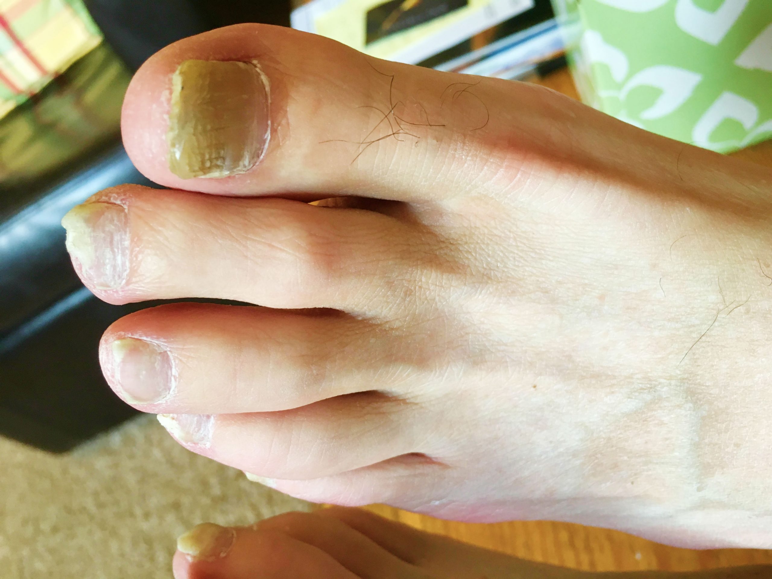 Can Toenail Fungus Spread To Other Parts Of The Body?