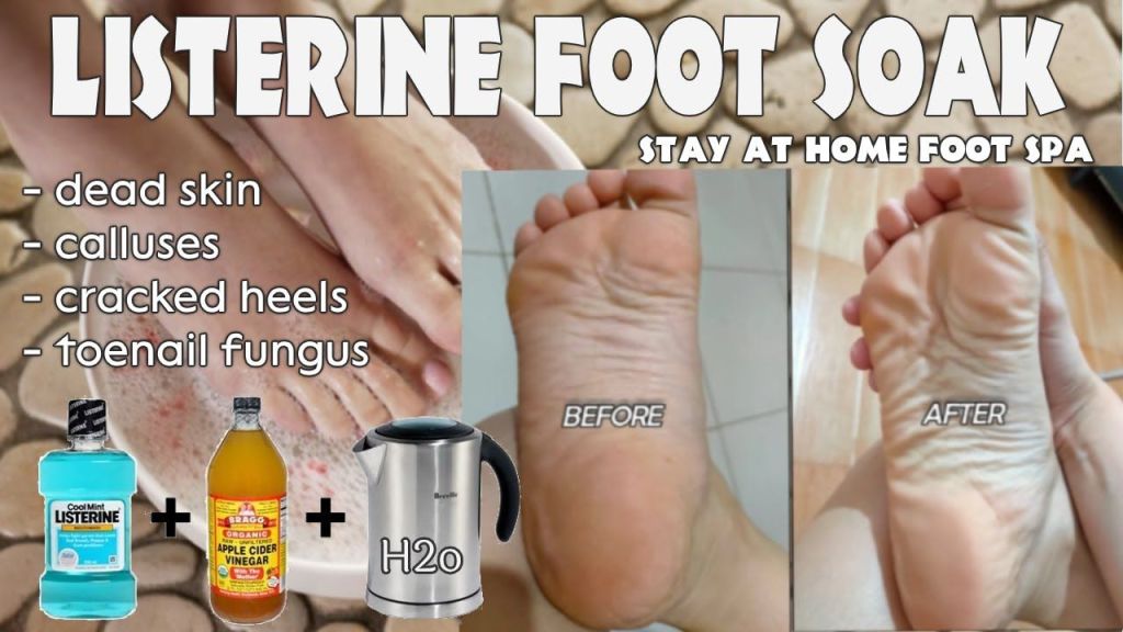 Can You Use Any Mouthwash For Foot Soak?