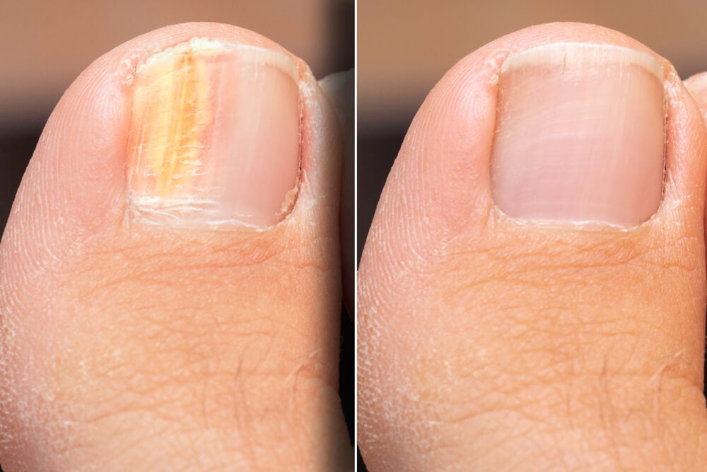 Causes and Treatments for Nail Fungus (Onychomycosis)