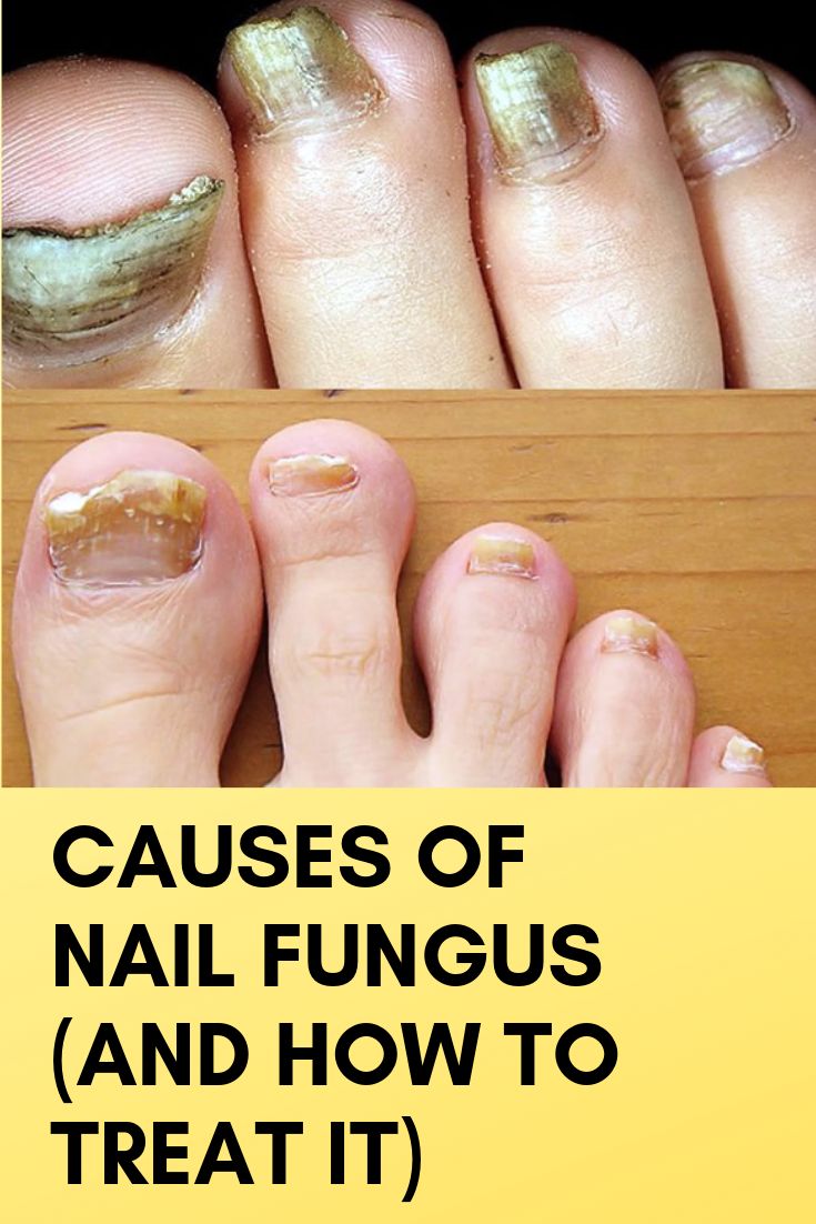 Causes of Nail Fungus (and How to Treat It)