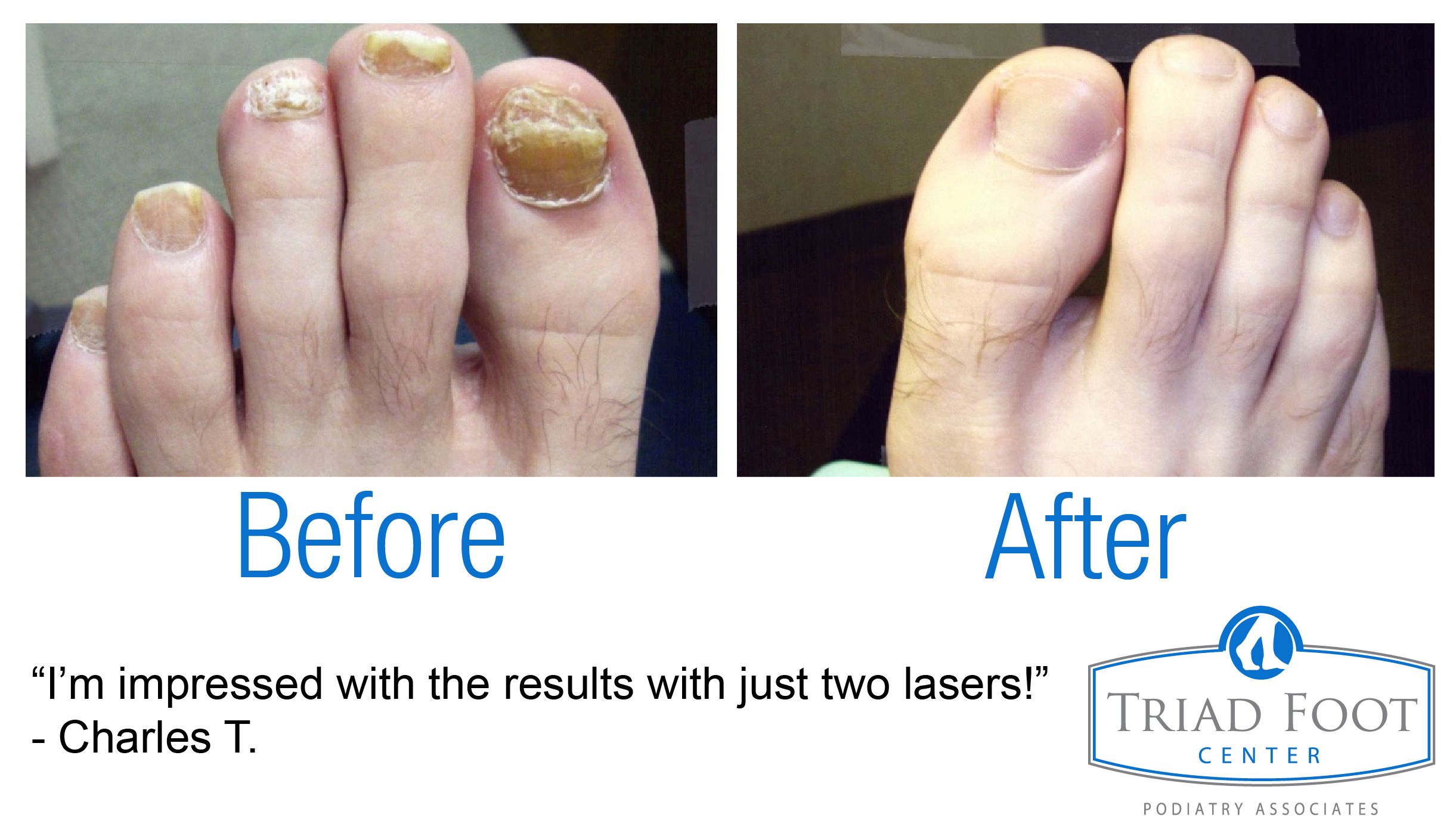 Charles loved the results of only two toenail fungus laser ...