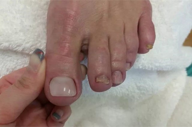 Cover Up Fungal Nails With the KeryFlex Nail Restoration ...