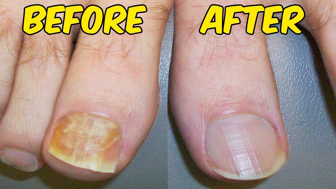 Cure Foot and Toenail Fungus Using Hydrogen Peroxide FAST!