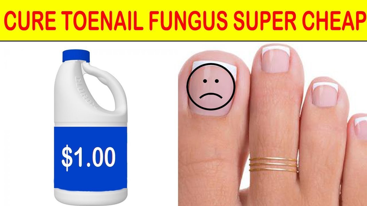 CURE TOENAIL FUNGUS: PAY LESS WITH BETTER RESULTS WITH HOUSEHOLD ITEM ...