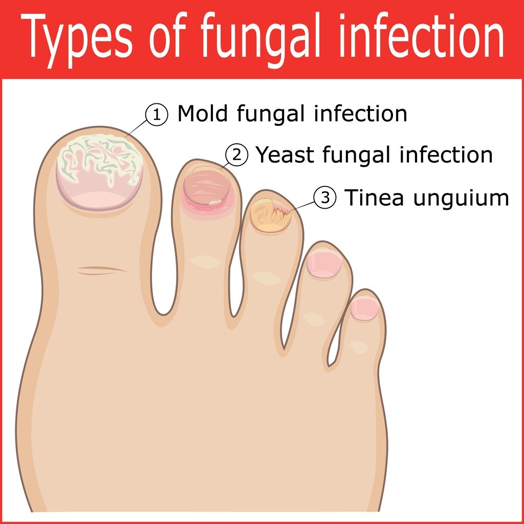 Cure Toenail Pain From Fungus Infection