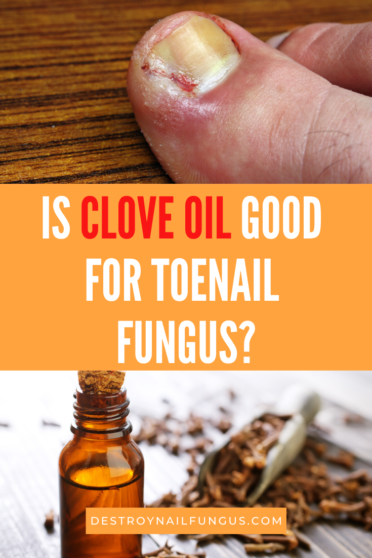 DIY Home Remedy: How To Use Clove Oil For Toenail Fungus