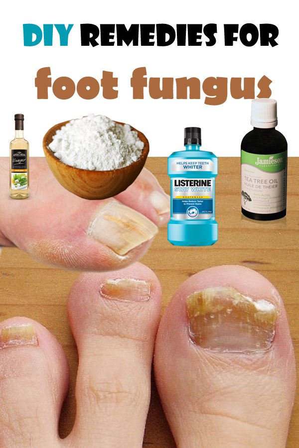 DIY remedies for foot fungus