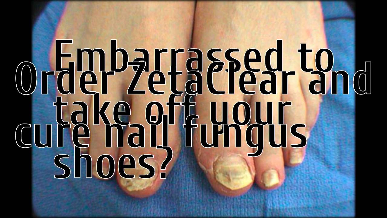 do i have toenail fungus