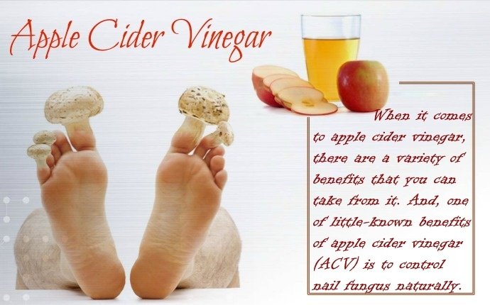 Does apple cider vinegar kill nail fungus?