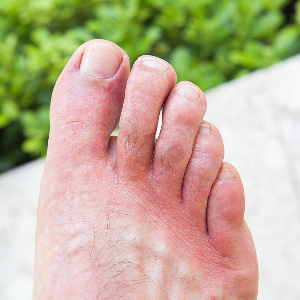 Does Foot Tendonitis Ever Go Away?