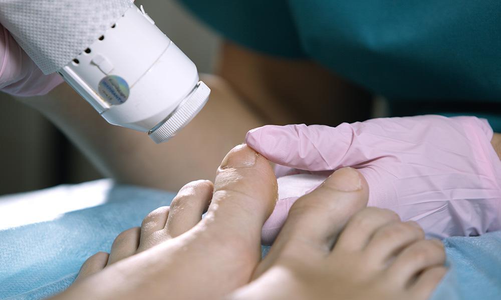 Does Laser Toenail Fungus Removal Work? A 2020 Review ...