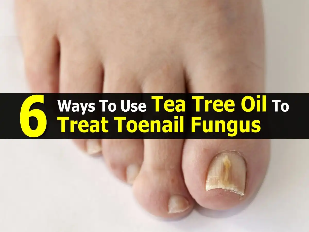 Does Tea Tree Oil Really Kill Toenail Fungus